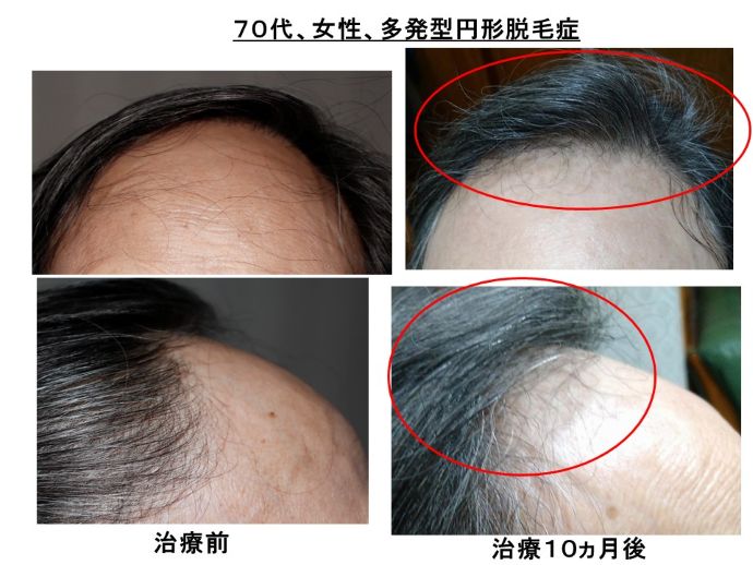 円形脱毛症　病院